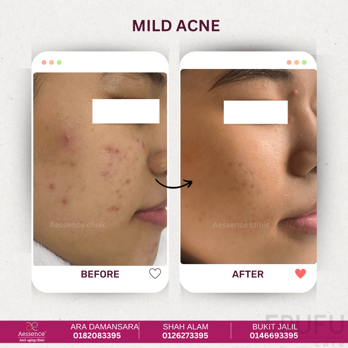 aessence-clinic-bukit-jalil-acne-treatment1-mydoctiny 你的脸值得更精致!马来西亚 5 大微整形专家助你蜕变!